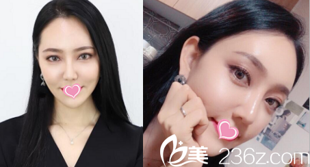 给你看我在韩国德嘉整形医院找金泽均做硅胶隆鼻和面部脂肪填充2月效果