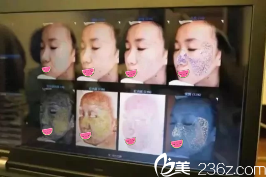 成都艺星Visia皮肤智能检测Visia皮肤智能检测结果