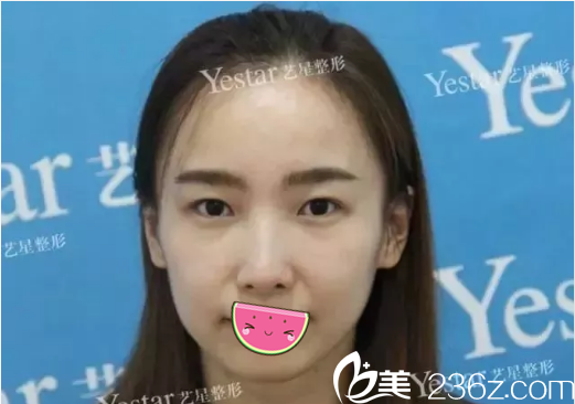 激光祛斑治疗术后斑痂脱落效果