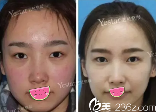 成都艺星激光祛斑术前术后对比效果