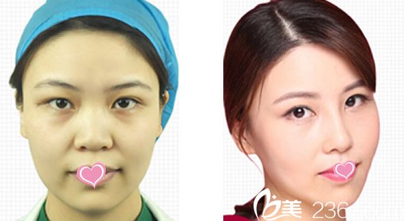 兰州亚韩整形医院员工面部精雕、隆鼻、双眼皮效果对比图
