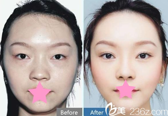 赵贵庆医生隆鼻+双眼皮+开眼角真人案例效果图片