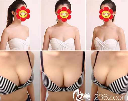 维多利亚刘中策自体脂肪隆胸案例对比图