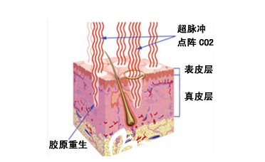 点阵激光治疗原理