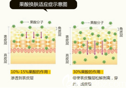 果酸换肤适应症示意图