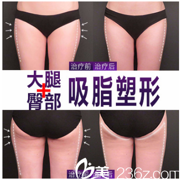 广东省第二人民医院整形美容科孙中生大腿吸脂案例