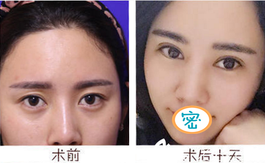 成都艺星何林双眼皮案例 成都艺星何林双眼皮案例