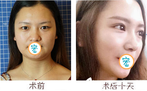 成都艺星何林双眼皮案例对比 成都艺星何林双眼皮案例对比