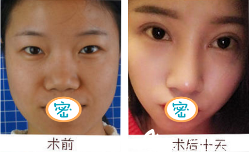 成都艺星何林双眼皮案例术前术后对比 成都艺星何林双眼皮案例术前术后对比