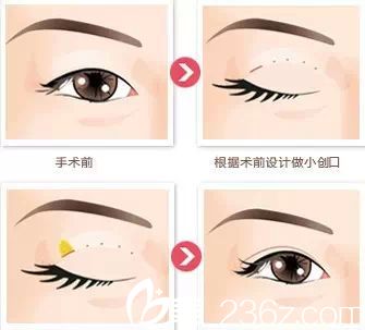 韩式双眼皮手术原理