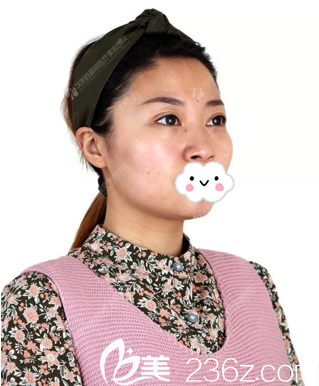 鼻综合术前照 鼻综合术前照