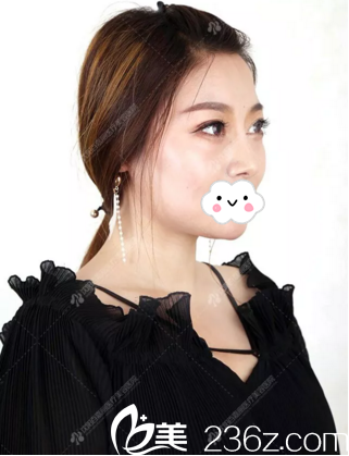 术后3个月恢复好后的鼻子 术后3个月恢复好后的鼻子