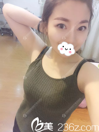 鼻综合半年后效果 鼻综合半年后效果