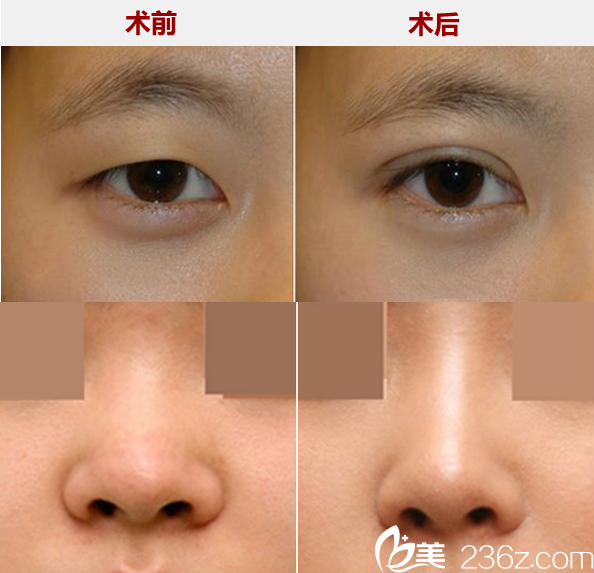 许春鹏双眼皮和假体隆鼻案例及前后对比效果