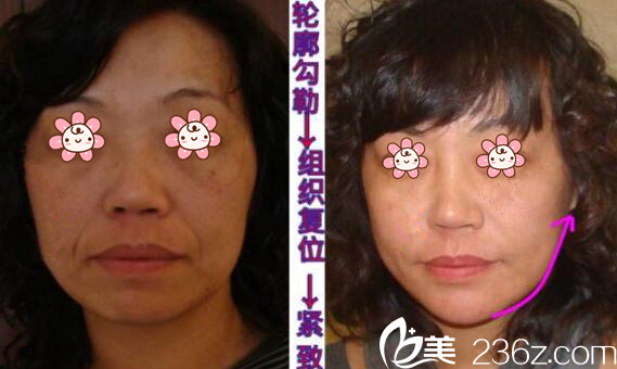 徐赤宇童颜针案例 徐赤宇童颜针案例