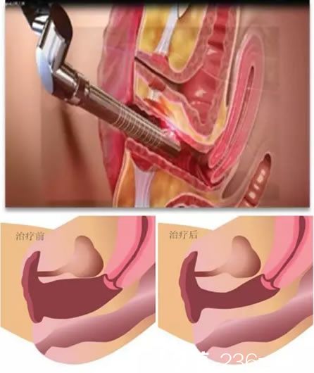 私密青春激光治疗过程及效果示意图 私密青春激光治疗过程及效果示意图