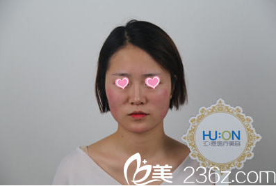 在北京汇恩医院体验金泰民注射隆鼻过程没想到前后20分钟左右效果美赞