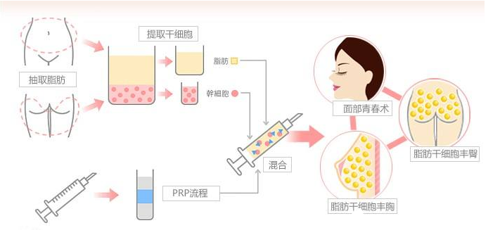自体脂肪隆胸 自体脂肪隆胸
