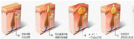 激光祛痘的原理 激光祛痘的原理