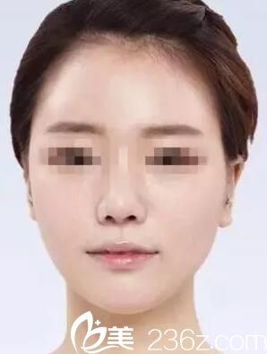 想了解柳州仁美杨克做面部自体脂肪填充效果好吗？看小何术后2个月的变化