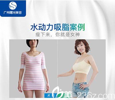 广州曙光医院万友望主任做的吸脂案例图片 广州曙光医院万友望主任做的吸脂案例图片