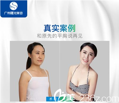 广州曙光医院万友望医生做的自体脂肪隆胸案例图片