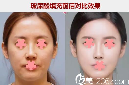玻尿酸填充全脸前后对比效果图