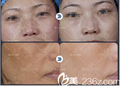 北京联合丽格医疗美容医院夏医生案例