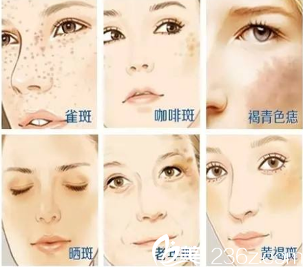 脸上斑点去不掉？南宁千美子激光祛斑1290元起帮你拥有白嫩肌肤