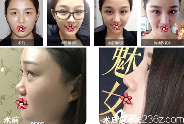 宁波壹秒整形眼鼻整形案例 宁波壹秒整形眼鼻整形案例