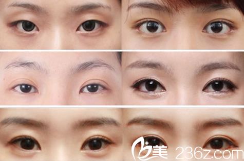 杭州市一医院整形外科双眼皮案例