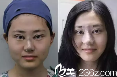 青岛市中心医院整形美容科做的双眼皮+假体隆鼻做完手术天