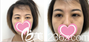韩国TheBidan德碧亶整形外科医院切开双眼皮+开眼角术前照 韩国TheBidan德碧亶整形外科医院切开双眼皮+开眼角术前照