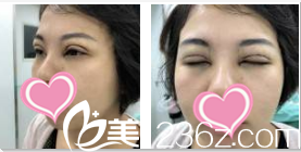 韩国TheBidan德碧亶整形外科医院田景旭眼部整形术后第四天效果 韩国TheBidan德碧亶整形外科医院田景旭眼部整形术后第四天效果