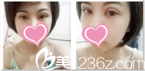 韩国TheBidan德碧亶整形外科双眼皮开眼角术后13天效果 韩国TheBidan德碧亶整形外科双眼皮开眼角术后13天效果