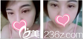 韩国TheBidan德碧亶整形外科医院艾双眼皮开眼角术后第28天样子 韩国TheBidan德碧亶整形外科医院艾双眼皮开眼角术后第28天样子