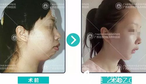 南宁爱思特颌面整形前后对比 南宁爱思特颌面整形前后对比