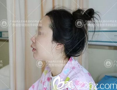 南宁爱思特颌面整形手术后5天 南宁爱思特颌面整形手术后5天