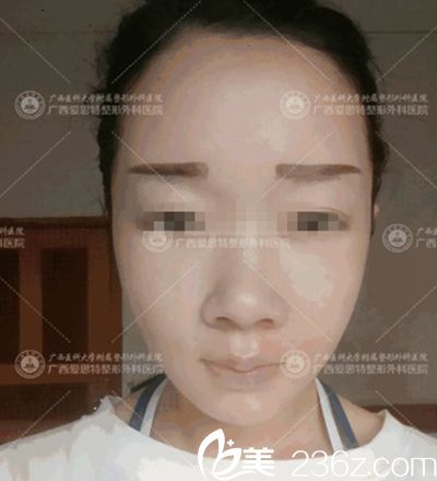 南宁爱思特颌面整形手术后20天 南宁爱思特颌面整形手术后20天