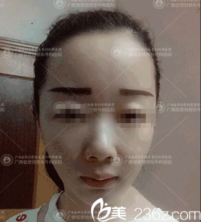 南宁爱思特颌面整形手术后1个月 南宁爱思特颌面整形手术后1个月