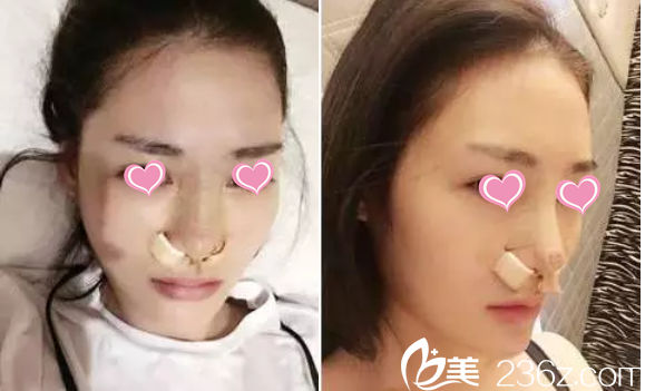 邹琪医生隆鼻案例 邹琪医生隆鼻案例