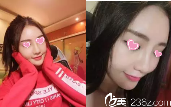 术后一个月 术后一个月