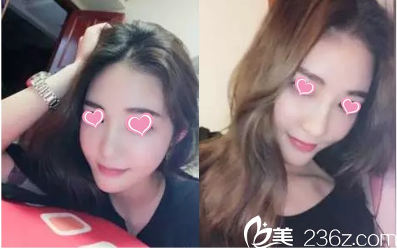 在做的鼻子术后三个月了，美成了小仙女