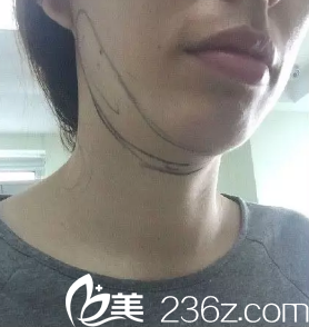 这是医生画线的时候 这是医生画线的时候