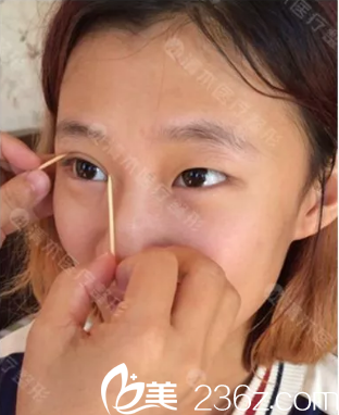 我在大同清木做双眼皮和开眼角术前照 我在大同清木做双眼皮和开眼角术前照