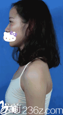 假体隆胸术前照 假体隆胸术前照