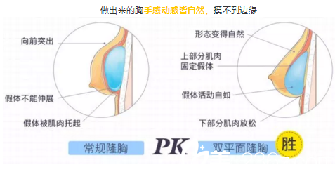 传统隆胸与双平面隆胸方式对比 传统隆胸与双平面隆胸方式对比