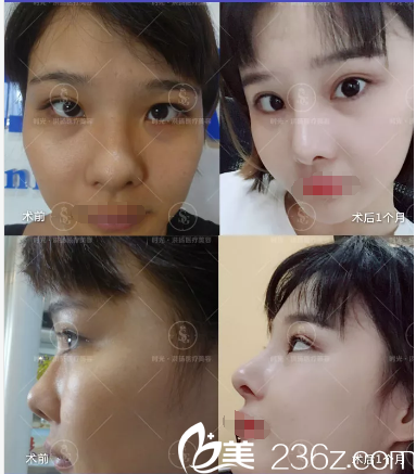 曹洪扬院长鼻综合+上睑下垂案例