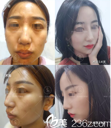 曹洪扬院长自体脂肪填充案例