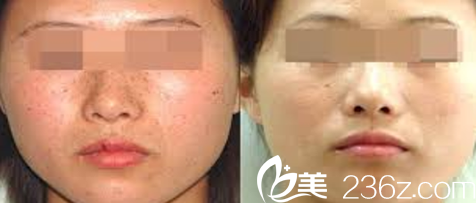 大同美神激光祛斑案例效果图